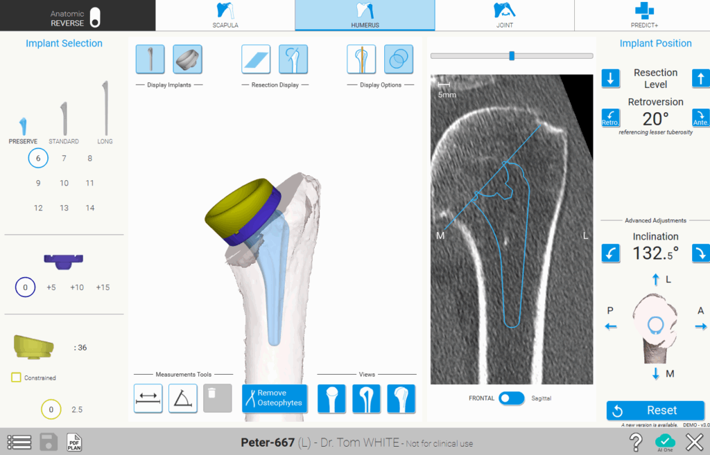 Oberarmplanung (Humerus Planning)