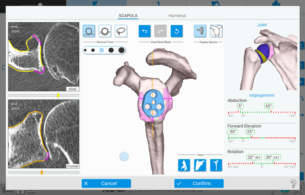 Osteophyten-Entfernung